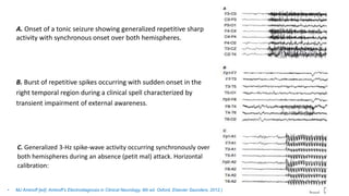A. Onset of a tonic seizure showing generalized repetitive sharp
activity with synchronous onset over both hemispheres.
B. Burst of repetitive spikes occurring with sudden onset in the
right temporal region during a clinical spell characterized by
transient impairment of external awareness.
C. Generalized 3-Hz spike-wave activity occurring synchronously over
both hemispheres during an absence (petit mal) attack. Horizontal
calibration:
• MJ Aminoff [ed]: Aminoff’s Electrodiagnosis in Clinical Neurology, 6th ed. Oxford, Elsevier Saunders, 2012.)
 