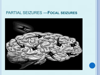PARTIAL SEIZURES ---FOCAL SEIZURES
 