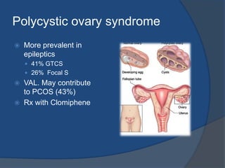 Catamenial epilepsy10-70% of epilepsy in womenType-I (Perimenstrual)Type-II (Periovulatory)Type-III (Second half of MC in anovlulatory cycle )Estrogen is pro-convulsant andProgesterone is anticonvulsantCyclical use of AnticonvulsantClobazam has show to be most effective (60-80%)Natural progesteron 200mg tid is effective used intermittentlyClomifen also has shown effective