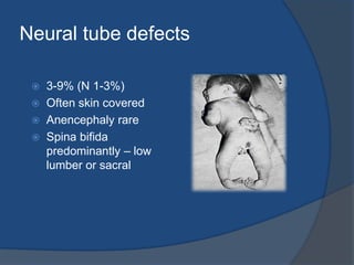 Effect of Epilepsy On PregnancyData  on 1st trimester losses, PROM (preturn rupture of membrane) ante-partum hemorrhage, operative vaginal delivery and CS are inconclusive.Increased incidence of IUGR(intra uterine growth retardation), cognitive dysfunction, microcephaly and perinatal mortality (1.2 - 3 times normal). Increased incidence of congenital malformations.