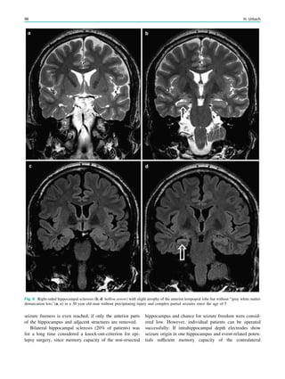 seizure freeness is even reached, if only the anterior parts
of the hippocampus and adjacent structures are removed.
Bilateral hippocampal sclerosis (20% of patients) was
for a long time considered a knock-out-criterion for epi-
lepsy surgery, since memory capacity of the non-resected
hippocampus and chance for seizure freedom were consid-
ered low. However, individual patients can be operated
successfully: If intrahippocampal depth electrodes show
seizure origin in one hippocampus and event-related poten-
tials sufﬁcient memory capacity of the contralateral
Fig. 6 Right-sided hippocampal sclerosis (b, d: hollow arrow) with slight atrophy of the anterior tempopral lobe but without ‘‘gray white matter
demarcation loss’’(a, c) in a 30 year old man without precipitating injury and complex partial seizures since the age of 5
98 H. Urbach
 