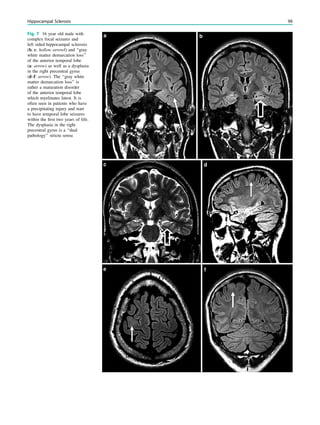 Fig. 7 16 year old male with
complex focal seizures and
left sided hippocampal sclerosis
(b, c: hollow arrowl) and ‘‘gray
white matter demarcation loss’’
of the anterior temporal lobe
(a: arrow) as well as a dysplasia
in the right precentral gyrus
(d–f: arrow). The ‘‘gray white
matter demarcation loss’’ is
rather a maturation disorder
of the anterior temporal lobe
which myelinates latest. It is
often seen in patients who have
a precipitating injury and start
to have temporal lobe seizures
within the ﬁrst two years of life.
The dysplasia in the right
precentral gyrus is a ‘‘dual
pathology’’ strictu sensu
Hippocampal Sclerosis 99
 