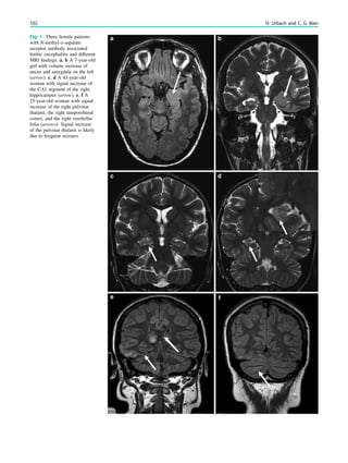 Fig. 1 Three female patients
with N-methyl-D-asparate
receptor antibody associated
limbic encephalitis and different
MRI ﬁndings. a, b A 7-year-old
girl with volume increase of
uncus and amygdala on the left
(arrow). c, d A 43-year-old
woman with signal increase of
the CA1 segment of the right
hippocampus (arrow). e, f A
25-year-old woman with signal
increase of the right pulvinar
thalami, the right temporobasal
cortex, and the right cerebellar
folia (arrows). Signal increase
of the pulvinar thalami is likely
due to frequent seizures
102 H. Urbach and C. G. Bien
 
