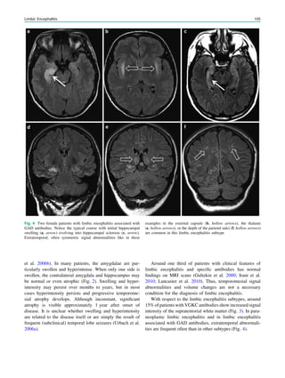 et al. 2006b). In many patients, the amygdalae are par-
ticularly swollen and hyperintense. When only one side is
swollen, the contralateral amygdala and hippocampus may
be normal or even atrophic (Fig. 2). Swelling and hyper-
intensity may persist over months to years, but in most
cases hyperintensity persists and progressive temporome-
sial atrophy develops. Although inconstant, signiﬁcant
atrophy is visible approximately 1 year after onset of
disease. It is unclear whether swelling and hyperintensity
are related to the disease itself or are simply the result of
frequent (subclinical) temporal lobe seizures (Urbach et al.
2006a).
Around one third of patients with clinical features of
limbic encephalitis and speciﬁc antibodies has normal
ﬁndings on MRI scans (Gultekin et al. 2000; Irani et al.
2010; Lancaster et al. 2010). Thus, temporomesial signal
abnormalities and volume changes are not a necessary
condition for the diagnosis of limbic encephalitis.
With respect to the limbic encephalitis subtypes, around
15% of patients with VGKC antibodies show increased signal
intensity of the supratentorial white matter (Fig. 3). In para-
neoplastic limbic encephalitis and in limbic encephalitis
associated with GAD antibodies, extratemporal abnormali-
ties are frequent often than in other subtypes (Fig. 4).
Fig. 4 Two female patients with limbic encephalitis associated with
GAD antibodies. Notice the typical course with initial hippocampal
swelling (a, arrow) evolving into hippocampal sclerosis (c, arrow).
Extratemporal, often symmetric signal abnormalities like in these
examples in the external capsule (b, hollow arrows), the thalami
(e, hollow arrows), or the depth of the parietal sulci (f, hollow arrows)
are common in this limbic encephalitis subtype
Limbic Encephalitis 105
 