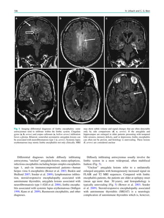 Differential diagnoses include diffusely inﬁltrating
astrocytoma, ‘‘unclear’’ amygdala lesions, status epilepticus,
infectious encephalitis including herpes simplex encephalitis
type 1, and—in immunocompromised patients—human
herpes virus 6 encephalitis (Bower et al. 2003; Baskin and
Hedlund 2007; Soeder et al. 2009), lymphomatous inﬁltra-
tion, steroid-responsive encephalopathy associated with
autoimmune thyroiditis, amygdala lesions associated with
neuroﬁbromatosis type 1 (Gill et al. 2006), limbic encepha-
litis associated with systemic lupus erythematosus (Stübgen
1998; Kano et al. 2009), Rasmussen encephalitis, and other
diagnoses.
Diffusely inﬁltrating astrocytomas usually involve the
limbic system in a more widespread, often multifocal
fashion (Fig. 5).
‘‘Unclear’’ amygdala lesions refer to a unilaterally
enlarged amygdala with homogenously increased signal on
FLAIR and T2 MRI sequences. Compared with limbic
encephalitis patients, the patients are older at epilepsy onset
(mean age more than 50 years), and histopathology is
typically unrevealing (Fig. 5) (Bower et al. 2003; Soeder
et al. 2009). Steroid-responsive encephalopathy associated
with autoimmune thyroiditis (SREAT) is a neurologic
complication of autoimmune thyroiditis which is, however,
Fig. 5 Imaging differential diagnoses of limbic encephalitis: some
astrocytomas tend to inﬁltrate within the limbic system. Cingulate
gyrus (a, b, arrow) and corpus callosum (a, hollow arrow) inﬁltration
favor a glioma. Bilateral, somewhat asymmetric amygdala lesions can
be associated with neuroﬁbromatosis type 1 (c, arrow). Systemic lupus
erythematosus may mimic limbic encephalitis not only clinically. MRI
may show subtle volume and signal changes that are often detectable
only by side comparisons (d, e, arrow). If the amygdala and
hippocampus are enlarged in older patients presenting with temporal
lobe seizures, memory deﬁcits, and/ or depression, limbic encephalitis
can often not be proven, and histology is unrevealing. These lesions
(f, arrow) are considered unclear
106 H. Urbach and C. G. Bien
 