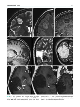 Fig. 3 a–c Small right frontal DNT, consisting only of the glioneu-
ronal element (simple variant). In contrast, the complex DNT variant
in case d–e shows a deep-seated calciﬁed portion. The interval
between g and h–i is 3 years: A ring-like contrast enhancing lesion in
the posterior tumor portion has disappeared (arrow), in another
location a new ring-enhancing lesion has occurred
Epilepsy Associated Tumors 113
 