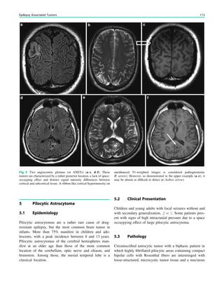 5 Pilocytic Astrocytoma
5.1 Epidemiology
Pilocytic astrocytomas are a rather rare cause of drug-
resistant epilepsy, but the most common brain tumor in
infants. More than 75% manifest in children and ado-
lescents, with a peak incidence between 8 and 13 years.
Pilocytic astrocytomas of the cerebral hemispheres man-
ifest at an older age than those of the more common
location of the cerebellum, optic nerve and chiasm, and
brainstem. Among those, the mesial temporal lobe is a
classical location.
5.2 Clinical Presentation
Children and young adults with focal seizures without and
with secondary generalization, # = $. Some patients pres-
ent with signs of high intracranial pressure due to a space
occuypying effect of large pilocytic astrocytoma.
5.3 Pathology
Circumscribed astrocytic tumor with a biphasic pattern in
which highly ﬁbrillated pilocytic areas containing compact
bipolar cells with Rosenthal ﬁbers are interminged with
loose-structured, microcystic tumor tissue and a mucinous
Fig. 5 Two angiocentric gliomas (or ANETs) (a–c, d–f). These
tumors are characterized by a rather posterior location, a lack of space-
occuyping effect and distinct signal intensity differences between
cortical and subcortical tissue. A ribbon-like cortical hyperintensity on
unenhanced T1-weighted images is considered pathognomonic
(f: arrow). However, as demonstrated in the upper example (a–c), it
may be absent or difﬁcult to detect (c: hollow arrow)
Epilepsy Associated Tumors 115
 