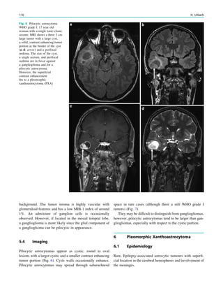 background. The tumor stroma is highly vascular with
glomeruloid features and has a low MIB-1 index of around
1%. An admixture of ganglion cells is occasionally
observed. However, if located in the mesial tempral lobe,
a ganglioglioma is more likely since the glial component of
a ganglioglioma can be pilocytic in appearance.
5.4 Imaging
Pilocytic astrocytomas appear as cystic, round to oval
lesions with a larger cystic and a smaller contrast enhancing
tumor portion (Fig. 6). Cysts walls occasionally enhance.
Pilocytic astrocytomas may spread through subarachnoid
space in rare cases (although there a still WHO grade I
tumors) (Fig. 7).
They may be difﬁcult to distinguish from gangliogliomas,
however, pilocytic astrocytomas tend to be larger than gan-
gliogliomas, especially with respect to the cystic portion.
6 Pleomorphic Xanthoastrocytoma
6.1 Epidemiology
Rare, Epilepsy-associated astrocytic tumours with superﬁ-
cial location in the cerebral hemispheres and involvement of
the meninges.
Fig. 6 Pilocytic astrocytoma
WHO grade I: 17 year old
woman with a single tonic-clonic
seizure. MRI shows a three 3 cm
large tumor with a large cyst,
a solid, contrast enhancing tumor
portion at the border of the cyst
(a–d: arrow) and a perifocal
oedema. The size of the cyst,
a single seizure, and perifocal
oedema are in favor against
a ganglioglioma and for a
pilocytic astrocytoma.
However, the superﬁcial
contrast enhancement
ﬁts to a pleomorphic
xanthoastrocytoma (PXA)
116 H. Urbach
 