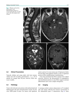 Fig. 7 Pilocytic astrocytoma
WHO grade I with
leptomeningeal spread in a
15 year old (a, b) and a 38 olde
man (c, d) with temporal lobe
seizures
6.2 Clinical Presentation
Typically children and young adults with focal seizures
without and with secondary generalization, # = $. 2/3 of
patients are younger than 20 years, however, PXAs also
occur in adults.
6.3 Pathology
Tumor with solid and cystic portions with multinucleated and
lipidized giant cells and a reticulin-positive stroma. In most
cases WHO grade II tumor. For tumors with signiﬁcant
mitotic activity (5 or more mitoses per 10 high power ﬁelds)
the term PXA with anaplastic features is used. A signiﬁcant
portion of PXAs dedifferentiates to glioblastomas.
It has been postulated that PXAs originate from subpial
astrocytes. However, the demonstration of synaptophysin
and neuroﬁlament protein in some PXAs suggests neuronal
differentiation and a more complex histogenesis.
6.4 Imaging
A meningo-cerebral contrast enhancement on T1-weighted
spin echo images reﬂecting the extensive involvement of
the subarachnoid space is characteristic (Fig. 8). Some
Epilepsy Associated Tumors 117
 