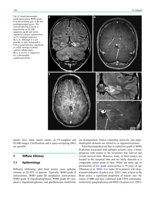 tumors have white matter edema on T2-weighted and
FLAIR images. Calciﬁcations and a space-occupying effect
are possible.
7 Diffuse Gliomas
7.1 Epidemiology
Diffusely inﬁltrating, glial brain tumors cause epileptic
seizures in 20–45% of patients. Typically, WHO grade II
astrocytomas, WHO grade III (anaplastic) astrocytomas,
WHO grade II oligodendrogliomas, WHO grade III (ana-
plastic) oligodendrogliomas, and glioblastomas multiforme
are distinguished. Tumor containing astrocytic and oligo-
dendroglial elements are refered to as oligoastrocytomas.
It has been hypothesized that so-called low grade or WHO
II gliomas associated with epileptic seizures carry a better
prognosis with respect to the recurrence free interval and
overall survival time. However, many of these tumors are
located in the temporal lobe and are likely detected at a
comparable earlier point of time: While the mean age of
presentation of low grade astrocytomas is 39 years of age
(Okamato et al. 2004), it is under 30 in patients with drug-
resistant epilepsies (Luyken et al. 2003). And, at least in the
Bonn series, a signiﬁcant proportion of tumors was—by
means of MRI and later conﬁrmed with CD34 immunohis-
tochemistry-gangliogliomas and DNTs (Luyken et al. 2003).
Fig. 8 Small pleomorphic
xanthosatrocytoma WHO grade
II of the posterior part of the left
parahippocampal gyrus. The
cortical/subcortical lesion is
hyperintense on FLAIR
sequences (a, d) and shows
superﬁcial contrast enhancement
on T1-weighted sequences
(b, c, e). Although it is not
possible to fully distinguish it
from a ganglioglioma, superﬁcial
so called meningo-cerebral
contrast enhancement
(b, c, e: arrow) is suggestive
for a pleomorphic
xanthosatrocytoma
118 H. Urbach
 