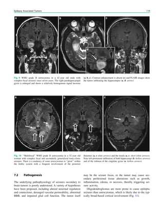 7.2 Pathogenesis
The underlying pathophysiology of seizures secondary to
brain tumors is poorly understood. A variety of hypotheses
have been proposed, including altered neuronal regulation
and connections, deranged vascular permeability, abnormal
BBB, and impaired glial cell function. The tumor itself
may be the seizure focus, or the tumor may cause sec-
ondary perilesional tissue alterations such as growth,
inﬂammation, edema, or necrosis, thereby triggering sei-
zure activity.
Oligodendrogliomas are more prone to cause epileptic
seizures than astrocytomas, which is likely due to the typ-
ically broad-based cortical involvement (Fig. 11).
Fig. 9 WHO grade II astrocytoma in a 42 year old male with
complex-focal seizures since seven years. The right parahippocampal
gyrus is enlarged and shows a relatively homogenous signal increase
(a, b, c). Contrast enhancement is absent (c) and FLAIR images show
the tumor inﬁltrating the hippocampus (a, d: arrow)
Fig. 10 ‘‘Multifocal’’ WHO grade II astrocytoma in a 52 year old
woman with complex focal and secondarily generalized tonic-clonic
seizures. There is a tendency of some astrocytomas to ‘‘grow’’ within
the limbic system with a frequent involvement of the posterior
thalamus (a, c white arrows) and the insula (a, c: short white arrows).
Note left-prominent inﬁltration of both hippocampi (b: hollow arrows)
and of the isthmus of the cingulate gyrus (a: hollow arrows)
Epilepsy Associated Tumors 119
 