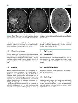 A signiﬁcant number of diffusely inﬁltrating astrocyto-
mas grows within or is ‘‘multifocal’’ in the limbic system, it
may be deﬁned as gliomatosis cerebri (Fig. 10).
7.3 Clinical Presentation
Epileptic seizures due to brain tumors typically manifest as
focal seizures with secondary generalization and are com-
monly refractory to antiepileptic drug treatment. Compared
to diffuse gliomas without epileptic seizures patients are
younger and gliomas are more often located in the temporal
lobe.
7.4 Imaging
Diffusely inﬁltrating astrocytomas are characterized by a
hyperintense space occuyping white matter lesion on
FLAIR and T2-weighted images (Fig. 9). Although the
lesion may appear well demarcated on MRI, tumor cells are
found beyond the abnormal signal intensity. Tumor inho-
mogeneity and contrast enhancement are considered to
indicate dedifferentiation or malignant progression to a
WHO grade III (anaplastic) astrocytoma.
Oligodendrogliomas typically involve the cortex and the
subcortical white matter. They are more inhomogenous as
compared to astrocytomas; inhomogeneity is caused by
typically clumped calciﬁcations, cystic changes and blood
products. Additional unenhanced CT is often helpful to
illustrate calciﬁcations (Fig. 11).
8 Epidermoid
8.1 Epidemiology
Developmental lesion without dermal appendages. 10–15%
of epidermoids are found in a parasellar, middle cranial
fossa location, where they tend to cause temporal lobe
seizures.
8.2 Clinical Presentation
Despite their congenital nature, they occur at any age with a
peak age around 40, # = $.
8.3 Pathology
Epidermoids are generally well-demarcated encapsulated
lesion with a mother-of-pearl sheen. The outer surface is
smooth, nodular or lobulated. Within the subarachnoid
space they tend to creep into clefts and ﬁssures and to
engulf blood vessels and nervs.
Fig. 11 Oligodendoglioma WHO grade III in a 43 year old woman
with three complex focal seizures. The tumor is somewhat inhomog-
enous (a) and shows no contrast enhancement (b). The broad cortical
inﬁltration (a: arrows) and clumpy calciﬁcations—as highlighted
with CT (c: arrow)—suggest the diagnosis oligodendroglioma or
oligoastrocytoma
120 H. Urbach
 