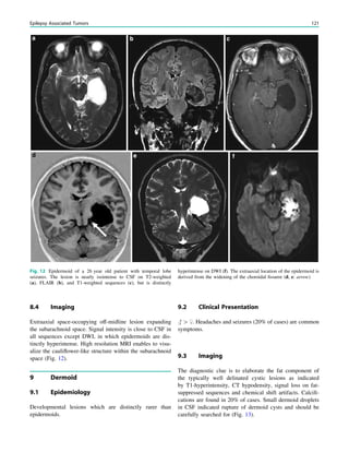 8.4 Imaging
Extraaxial space-occupying off-midline lesion expanding
the subarachnoid space. Signal intensity is close to CSF in
all sequences except DWI, in which epidermoids are dis-
tinctly hyperintense. High resolution MRI enables to visu-
alize the cauliﬂower-like structure within the subarachnoid
space (Fig. 12).
9 Dermoid
9.1 Epidemiology
Developmental lesions which are distinctly rarer than
epidermoids.
9.2 Clinical Presentation
# [ $. Headaches and seizures (20% of cases) are common
symptoms.
9.3 Imaging
The diagnostic clue is to elaborate the fat component of
the typically well delinated cystic lesions as indicated
by T1-hyperintensity, CT hypodensity, signal loss on fat-
suppressed sequences and chemical shift artifacts. Calciﬁ-
cations are found in 20% of cases. Small dermoid droplets
in CSF indicated rupture of dermoid cysts and should be
carefully searched for (Fig. 13).
Fig. 12 Epidermoid of a 26 year old patient with temporal lobe
seizures. The lesion is nearly isointense to CSF on T2-weighted
(a), FLAIR (b), and T1-weighted sequences (c), but is distinctly
hyperintense on DWI (f). The extraaxial location of the epidermoid is
derived from the widening of the choroidal ﬁssurre (d, e: arrow)
Epilepsy Associated Tumors 121
 