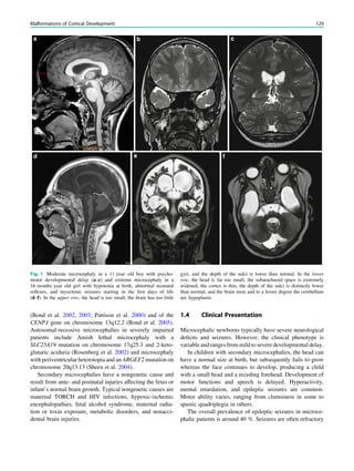 (Bond et al. 2002, 2003; Pattison et al. 2000) and of the
CENPJ gene on chromosome 13q12.2 (Bond et al. 2005).
Autosomal-recessive microcephalies in severely impaired
patients include Amish lethal microcephaly with a
SLC25A19 mutation on chromosome 17q25.3 and 2-keto-
glutaric aciduria (Rosenberg et al. 2002) and microcephaly
with periventricular heterotopia and an ARGEF2 mutation on
chromosome 20q13.13 (Sheen et al. 2004).
Secondary microcephalies have a nongenetic cause and
result from ante- and postnatal injuries affecting the fetus or
infant’s normal brain growth. Typical nongenetic causes are
maternal TORCH and HIV infections, hypoxic-ischemic
encephalopathies, fetal alcohol syndrome, maternal radia-
tion or toxin exposure, metabolic disorders, and nonacci-
dental brain injuries.
1.4 Clinical Presentation
Microcephalic newborns typically have severe neurological
deﬁcits and seizures. However, the clinical phenotype is
variable and ranges from mild to severe developmental delay.
In children with secondary microcephalies, the head can
have a normal size at birth, but subsequently fails to grow
whereas the face continues to develop, producing a child
with a small head and a receding forehead. Development of
motor functions and speech is delayed. Hyperactivity,
mental retardation, and epileptic seizures are common.
Motor ability varies, ranging from clumsiness in some to
spastic quadriplegia in others.
The overall prevalence of epileptic seizures in microce-
phalic patients is around 40 %. Seizures are often refractory
Fig. 1 Moderate microcephaly in a 11 year old boy with psycho-
motor developmental delay (a–c) and extreme microcephaly in a
16 months year old girl with hypotonia at birth, abnormal neonatal
reﬂexes, and myoclonic seizures starting in the ﬁrst days of life
(d–f). In the upper row, the head is too small, the brain has too little
gyri, and the depth of the sulci is lower than normal. In the lower
row, the head is far too small, the subarachnoid space is extremely
widened, the cortex is thin, the depth of the sulci is distinctly lower
than normal, and the brain stem and to a lesser degree the cerebellum
are hypoplastic
Malformations of Cortical Development 129
 