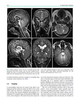 to medical treatment and more common in secondary than
in primary forms (Ashwal et al. 2009).
1.5 Imaging
A microcephalic head may be missed if the child is not
inspected and the technician adapts the ﬁeld of view to the
child’s head size. However, considering the cranio–facial
ratio and the ratios between hindbrain and forebrain on a
midsagittal T1-weighted image should guide the MRI reader
to the correct diagnosis. The cranio–facial ratio relates the
size of the intracranial structures to the size of the face. The
ratio is normally large at birth and slowly diminishes with
increasing age. It is typically small in microcephalic
patients. Hindbrain and forebrain structures can be propor-
tional to each other, however, in many cases cerebellum and
brain stem are disproportionally large (Adachi et al. 2011).
The size of the forebrain correlates with (1) the gryal
pattern: severe microcephalic brains typically have an
extremely simpliﬁed gyral pattern (Adachi et al. 2011). It
also correlates with (2) the white matter volume, and (3)
associated callosal anomalies. In most patients, the corpus
callosum is hypoplastic (thin, but all parts are formed); in
Fig. 2 Patau syndrome (trisomy 13) in a 18 months old boy with
generalized tonic-clonic seizures. The boy shows moderate micro-
cephaly, the cortex is of normal thickness and the sulci are of normal
depth. Note the disproportionate size of the posterior fossa (a, c–d:
arrow, e–f), cerebellar dysplasia (c: thick arrow), hypogenetic corpus
callosum, small ocular globes, malrotated hipoocampi, (e), and
olfactory bulb hypoplasia (b: hollow arrow)
130 H. Urbach and S. Greschus
 