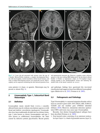 some patients it is hypo- or agenetic. Heterotopia may be
present or absent (Fig. 4).
2 Lissencephaly Type 1, Subcortical Band
Heterotopia
2.1 Definition
Lissencephaly means smooth brain (kirro1 = smooth);
affected brains may be without convolutions (agyria) or with
broad and shallow convolutions (pachygyria). Lissenceph-
alies have been traditionally divided into two distinct forms:
type 1 (also known as classic) lissencephalies and type 2
(also known as cobblestone) lissencephalies, the latter
caused by defective protein glycolisation. Recent genetic
and pathologic ﬁndings have questioned this two-tiered
classiﬁcation and suggest at least four different lissencephaly
types (Barkovich et al. 2012; Forman et al. 2005).
2.2 Pathogenesis and Pathology
Type I lissencephaly is a neuronal migration disorder with at
least six causative genes (LIS1, DCX, RELN, ARX, TUBA1A,
VLDLR) and one modiﬁer gene (YWHAE) identiﬁed
(Dobyns 2010). Moreover, intrauterine infections (particu-
larly CMV) and toxins may cause type I lissencephaly.
Recently, four distinct histopathological subtypes have
been described (Forman et al. 2005):
1. Four-layered cortex consisting of an outermost molecu-
lar layer (layer 1), a band of pyramidal neurons (layer 2),
Fig. 3 A 2 year old girl presented with seizures since the age of
2 months. Mowat-Wilson syndrome, a complex developmental disor-
der with microcephaly, mental retardation, distinct facial features, and
with or without Hirschsprung disease was genetically proven. Micro-
cephaly can be suspected considering the ratio between posterior fossa
and supratentorial structures (a). However, complete corpus callosum
agenesis is the most striking MRI ﬁnding (a–f). See the lateral callosal
bundles of Probst as hypointense stripes on T2-weighted images
running parallel to the interhemispheric ﬁssure and indenting the
medial walls of the lateral ventricles (e: arrows)
Malformations of Cortical Development 131
 