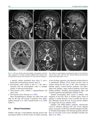 a sparsely cellular myelinated layer (layer 3), and a
broad band of disorganized neurons (layer 4)
2. Four-layered cortex similar to that in 1, but with a
transition from the lissencephalic cortex to multiple
nodules of subcortical heterotopia
3. Three-layered cortex without a hypomyelinated cell
sparse zone
4. Two-layered cortex (Forman et al. 2005).
These histopathological subytpes also differ from each
other by the type and severity of posterior fossa abnor-
malities (Forman et al. 2005; Jissendi-Tchofo et al. 2009)
(Table 3).
2.3 Clinical Presentation
Children with type 1 lissencephalies typically present with
neurological deﬁcits in the ﬁrst weeks or months consisting
of poor feeding, hypotonia, and abnormal arching behavior
or opisthotonus (Dobyns 2010). Nearly all have onset of
seizures during the ﬁrst year of life, often consisting of
infantile spasms, Lennox–Gastaut syndrome, and others.
Apart from epilepsy, major medical problems result from
feeding problems including gastroesophageal reﬂux and
recurrent aspiration and pneumonia (Dobyns 2010).
Isolated lissencephaly (ILS) occurs in patients with
mutations of the LIS1, DCX, or TUBA1A genes. Onset of
epilepsy is usually between 3 and 12 months, but may be
later. Mortality exceeds 50 % by 10 years and few children
live longer than 20 years (Dobyns 2010).
Children with Miller–Dieker syndrome (chromosome
17p13(.3) deletions affecting LIS1 and several adjacent
genes), most types of LIS with cerebellar hypoplasia (LCH),
or X-linked lissencephaly with abnormal genitalia (XLAG)
have an even more severe course and higher mortality rate
(Ross et al. 2001).
Fig. 4 A 20 year old boy with microcephaly, micrognathy, and short
status suggestive of a Seckel syndrome suffered from complex focal
and generalized seizures since the age of 10. Note that microcephaly is
best visible on sagittal images considering the relative sizes of the face
and the brain (a–c). This boy also showed bilateral periventricular
nodular heterotopia (d–f: arrows)
132 H. Urbach and S. Greschus
 