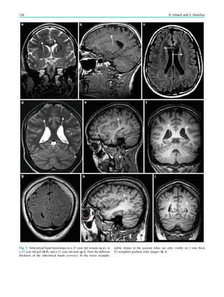 Fig. 7 Subcortical band heterotopia in a 21 year old woman (a–c), in
a 13 year old girl (d–f), and a 31 year old man (g–i). Note the different
thickness of the subcortical bands (arrows). In the lower example,
subtle stripes in the parietal lobes are only visible on 1 mm thick
T1-weighted gradient echo images (h, i)
136 H. Urbach and S. Greschus
 