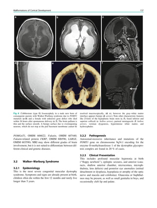 POMGnT1, OMIM 606822; Fukutin, OMIM 607440;
Fukutin-related protein FKRP, OMIM 606596; LARGE,
OMIM 603590). MRI may show different grades of brain
involvement, but it is not suited to differentiate between dif-
ferent clinical and genetic diseases.
3.2 Walker–Warburg Syndrome
3.2.1 Epidemiology
This is the most severe congenital muscular dystrophy
syndrome. Symptoms and signs are already present at birth,
children often die within the ﬁrst 12 months and rarely live
longer than 5 years.
3.2.2 Pathogenesis
Autosomal-recessive inheritance and mutations of the
POMT1 gene on chromsosome 9q34.1 encoding for the
enzyme O-methyltransferase 1 of the dystrophin glycopro-
tein complex are found in 20 % of cases.
3.2.3 Clinical Presentation
This includes profound muscular hypotonia at birth
(‘‘ﬂoppy newborn’’), epileptic seizures, and anterior (cata-
racts, shallow anterior chamber, microcornea, microph-
thalmia, lens defects) and posterior eye anomalies (retinal
detachment or dysplasia, hypoplasia or atrophy of the optic
nerve and macula and coloboma). Glaucoma or buphthal-
mos may be present, as well as small genitalia in boys, and
occasionally cleft lip and palate.
Fig. 8 Cobblestone (type II) lissencephaly in a male new born of
consanguine parents with Walker-Warburg syndrome due to POMT1
mutation (a–d) and a female with unknown gene defect who died
within 36 hours after spontaneous delivery (e, f). The brain pallium is
thin and the surface smooth. A bumpy surface due to overmigrating
neurons, which do not stop at the pial basement membrane cannot be
resolved macroscopically, (d, e), however the gray–white matter
interface appears bumpy (d: arrow). Note other characteristic features
like Z-form of the hypoplastic brain stem (c, f), fused inferior and
superior colliculi (c: hollow arrow), parietal meningocele (f: hollow
arrow), vermian dysgenesis, hyperintense white matter, and
hydrocephalus
Malformations of Cortical Development 137
 