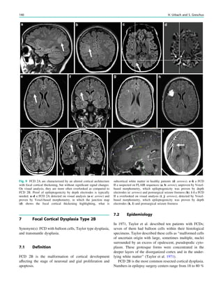 7 Focal Cortical Dysplasia Type 2B
Synonym(s): FCD with balloon cells, Taylor type dysplasia,
and transmantle dysplasia.
7.1 Definition
FCD 2B is the malformation of cortical development
affecting the stage of neuronal and gial proliferation and
apoptosis.
7.2 Epidemiology
In 1971, Taylor et al. described ten patients with FCDs;
seven of them had balloon cells within their histological
specimens. Taylor described these cells as ‘‘malformed cells
of uncertain origin with large, sometimes multiple, nuclei
surrounded by an excess of opalescent, pseudopodic cyto-
plasm. These grotesque forms were concentrated in the
deeper layers of the disorganized cortex and in the under-
lying white matter’’ (Taylor et al. 1971).
FCD 2B is the most common resected cortical dysplasia.
Numbers in epilepsy surgery centers range from 18 to 80 %
Fig. 9 FCD 2A are characterized by an altered cortical architecture
with focal cortical thickening, but without signiﬁcant signal changes.
On visual analysis, they are more often overlooked as compared to
FCD 2B. Proof of epileptogenicity by depth electrodes is typically
needed. a–d a FCD 2A detected on visual analysis (a–c: arrow) and
proven by Voxel-based morphometry, in which the junction map
(d) shows the focal cortical thickening highlighting, what is
subcortical white matter in healthy patients (d: arrows). e–h a FCD
II a suspected on FLAIR sequences (a, b: arrow), unproven by Voxel-
based morphometry, which epileptogenicity was proven by depth
electrodes (c: arrows) and postsurgical seizure freeness (h). i–l a FCD
II a overlooked on visual analysis (i, j: arrows), detected by Voxel-
based morphometry, which epileptogenicity was proven by depth
electrodes (k, l) and postsurgical seizure freeness
140 H. Urbach and S. Greschus
 