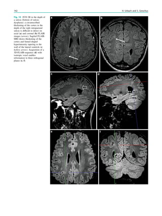 Fig. 10 FCD 2B in the depth of
a sulcus (bottom of sulcus-
dysplasia): a circumscribed
thickening of the cortex in the
depth of the right intraparietal
sulcus is difﬁcult to detect on
axial (a) and coronal (b) FLAIR
images (arrow). Sagittal FLAIR-
MRI shows thickening of the
cortex and funnel-shaped
hyperintensity tapering to the
wall of the lateral ventricle (c:
hollow arrow). Acquisition of a
3D-FLAIR-sequence (d) with
isotropic voxel enables
reformation in three orthogonal
planes (e, f)
142 H. Urbach and S. Greschus
 