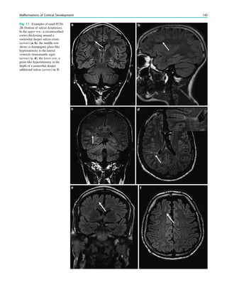 Fig. 11 Examples of small FCDs
2B (bottom of sulcus dysplasias).
In the upper row, a circumscribed
cortex thickening around a
somewhat deeper sulcus exists
(arrow) (a, b), the middle row
shows a champagner glass-like
hyperintensity to the lateral
ventricle (transmantle sign)
(arrow) (c, d), the lower row, a
point-like hyperintensity in the
depth of a somewhat deeper
additional sulcus (arrow) (e, f)
Malformations of Cortical Development 143
 
