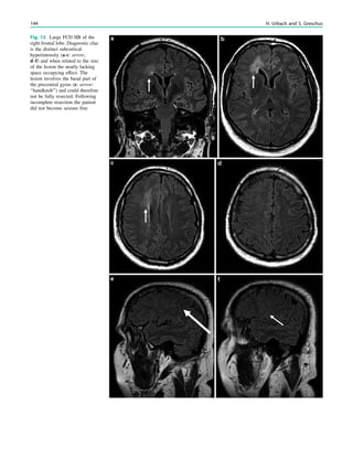 Fig. 12 Large FCD IIB of the
right frontal lobe. Diagnostic clue
is the distinct subcortical
hyperintensity (a-c: arrow,
d–f) and when related to the size
of the lesion the nearly lacking
space occupying effect. The
lesion involves the basal part of
the precentral gyrus (e: arrow:
‘‘handknob’’) and could therefore
not be fully resected. Following
incomplete resection the patient
did not become seizure free
144 H. Urbach and S. Greschus
 