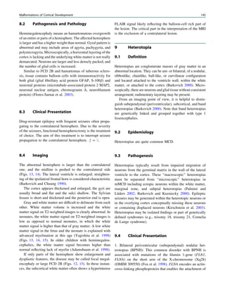 8.2 Pathogenesis and Pathology
Hemimegalencephaly means an hamartomatous overgrowth
of an entire or parts of a hemisphere. The affected hemisphere
is larger and has a higher weight than normal. Gyral pattern is
abnormal and may include areas of agyria, pachygyria, and
polymicrogyria. Microscopically, a horizontal layering of the
cortex is lacking and the underlying white matter is not really
demarcated. Neurons are larger and less densely packed, and
the number of glial cells is increased.
Similar to FCD 2B and hamartomas of tuberous sclero-
sis, tissue contains balloon cells with immunoreactivity for
both glial (glial ﬁbrillary acid protein GFAP, S-100b) and
neuronal proteins (microtubule-associated protein 2 MAP2,
neuronal nuclear antigen, chromogranin A, neuroﬁlament
protein) (Flores-Sarnat et al. 2003).
8.3 Clinical Presentation
Drug-resistant epilepsy with frequent seizures often propa-
gating to the contralateral hemisphere. Due to the severity
of the seizures, functional hemispherectomy is the treatment
of choice. The aim of this treatment is to interrupt seizure
propagation to the contralateral hemisphere. # = $.
8.4 Imaging
The abnormal hemisphere is larger than the contralateral
one, and the midline is pushed to the contralateral side
(Figs. 13, 14). The lateral ventricle is enlarged; straighten-
ing of the ipsilateral frontal horn is considered characteristic
(Barkovich and Chuang 1990).
The cortex appears thickened and enlarged, the gyri are
usually broad and ﬂat and the sulci shallow. The Sylvian
ﬁssure is short and thickened and the posterior end is open.
Gray and white matter are difﬁcult to delineate from each
other. White matter volume is increased and the white
matter signal on T2-weighted images is clearly abnormal. In
neonates, the white matter signal on T2-weighted images is
low as opposed to normal neonates, in which the white
matter signal is higher than that of gray matter. A low white
matter signal in the fetus and the neonate is explained with
advanced myelination at this age (Yagishita et al. 1998)
(Figs. 13, 14, 15). In older children with hemimegalen-
cephalies, the white matter signal becomes higher than
normal reﬂecting lack of myelin (Adamsbaum et al. 1998).
If only parts of the hemisphere show enlargement and
dysplastic features, the disease may be called focal megal-
encephaly or large FCD 2B (Figs. 12, 15). In these instan-
ces, the subcortical white matter often shows a hyperintense
FLAIR signal likely reﬂecting the balloon-cell rich part of
the lesion. The critical part in the interpretation of the MRI
is the exclusion of a contralateral lesion.
9 Heterotopia
9.1 Definition
Heterotopias are conglomerate masses of gray matter in an
abnormal location. They can be uni- or bilateral, of a nodular,
ribbonlike, chainlike, ball-like, or curvilinear conﬁguration
and located attached to the ventricle wall, within the white
matter, or attached to the cortex (Barkovich 2000). Micro-
scopically, there are neurons and glial tissue without consistent
arrangement; rudimentary layering may be present.
From an imaging point of view, it is helpful to distin-
guish subependymal (periventricular), subcortical, and band
heterotopias (Barkovich 2000). Note that band heterotopias
are genetically linked and grouped together with type 1
lissencephalies.
9.2 Epidemiology
Heterotopias are quite common MCD.
9.3 Pathogenesis
Heterotopias typically result from impaired migration of
neurons from the germinal matrix in the wall of the lateral
ventricle to the cortex. These ‘‘macroscopic’’ heterotopias
must be separated from ‘‘microscopic’’ heterotopias in
mMCD including ectopic neurons within the white matter,
marginal zone, and subpial heterotopias (Palmini and
Lüders 2002; Barkovich and Kuzniecky 2000). Epileptic
seizures may be generated within the heterotopic neurons or
in the overlying cortex conceptually missing these neurons
or containing displaced neurons (Kirschstein et al. 2003).
Heterotopias may be isolated ﬁndings or part of genetically
deﬁned syndromes (e.g., trisomy 18, trisomy 21, Cornelia
de Lange syndrome).
9.4 Clinical Presentation
1. Bilateral periventricular (subependymal) nodular het-
erotopias (BPNH): This common disorder with BPNH is
associated with mutations of the ﬁlamin 1-gene (FLN1,
FLNA) on the short arm of the X-chromosome (Xq28)
(OMIM 309550) (Fox et al. 1998). FLNA encodes an actin-
cross-linking phosphoprotein that enables the attachment of
Malformations of Cortical Development 145
 