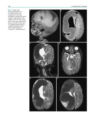 Fig. 13 Right-sided
hemimegalencephaly in a
10 months old boy with
enlargement of the right
hemisphere including the lateral
ventricle, displacement of the
mildline to the left side, nearly
agyric cortex, poor demarcation
of gray and white matter, and
T1-weighted hyperintense/T2-
weighted hypointense white
matter signal suggesting
‘‘advanced’’ myelination (a–f)
146 H. Urbach and S. Greschus
 