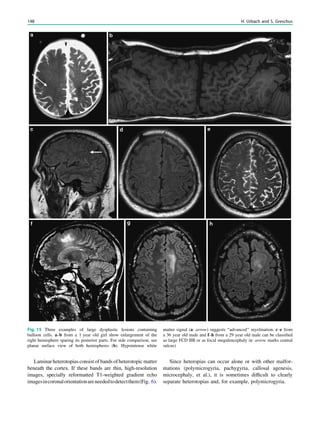 Laminar heterotopias consist of bands of heterotopic matter
beneath the cortex. If these bands are thin, high-resolution
images, specially reformatted T1-weighted gradient echo
imagesincoronalorientationareneededtodetectthem(Fig. 6).
Since heteropias can occur alone or with other malfor-
mations (polymicrogyria, pachygyria, callosal agenesis,
microcephaly, et al.), it is sometimes difﬁcult to clearly
separate heterotopias and, for example, polymicrogyria.
Fig. 15 Three examples of large dysplastic lesions containing
balloon cells. a–b from a 1 year old girl show enlargement of the
right hemisphere sparing its posterior parts. For side comparison, see
planar surface view of both hemispheres (b). Hypointense white
matter signal (a: arrow) suggests ‘‘advanced’’ myelination. c–e from
a 36 year old male and f–h from a 29 year old male can be classiﬁed
as large FCD IIB or as focal megalencephaly (c: arrow marks central
sulcus)
148 H. Urbach and S. Greschus
 