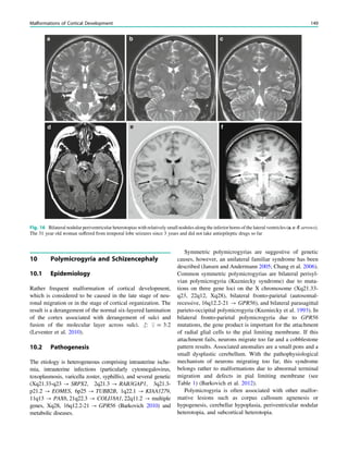 10 Polymicrogyria and Schizencephaly
10.1 Epidemiology
Rather frequent malformation of cortical development,
which is considered to be caused in the late stage of neu-
ronal migration or in the stage of cortical organization. The
result is a derangement of the normal six-layered lamination
of the cortex associated with derangement of sulci and
fusion of the molecular layer across sulci. #: $ = 3:2
(Leventer et al. 2010).
10.2 Pathogenesis
The etiology is heterogeneous comprising intrauterine ische-
mia, intrauterine infections (particularly cytomegalovirus,
toxoplasmosis, varicella zoster, syphillis), and several genetic
(Xq21.33-q23 ? SRPX2, 2q21.3 ? RAB3GAP1, 3q21.3-
p21.2 ? EOMES, 6p25 ? TUBB2B, 1q22.1 ? KIAA1279,
11q13 ? PAX6, 21q22.3 ? COLI18A1, 22q11.2 ? multiple
genes, Xq28, 16q12.2-21 ? GPR56 (Barkovich 2010) and
metabolic diseases.
Symmetric polymicrogyrias are suggestive of genetic
causes, however, an unilateral familiar syndrome has been
described (Jansen and Andermann 2005; Chang et al. 2006).
Common symmetric polymicrogyrias are bilateral perisyl-
vian polymicrogyria (Kuzniecky syndrome) due to muta-
tions on three gene loci on the X chromosome (Xq21.33-
q23, 22q12, Xq28), bilateral fronto-parietal (autosomal-
recessive, 16q12.2-21 ? GPR56), and bilateral parasagittal
parieto-occipital polymicrogyria (Kuzniecky et al. 1993). In
bilateral fronto-parietal polymicrogyria due to GPR56
mutations, the gene product is important for the attachment
of radial glial cells to the pial limiting membrane. If this
attachment fails, neurons migrate too far and a cobblestone
pattern results. Associated anomalies are a small pons and a
small dysplastic cerebellum. With the pathophysiological
mechanism of neurons migrating too far, this syndrome
belongs rather to malformations due to abnormal terminal
migration and defects in pial limiting membrane (see
Table 1) (Barkovich et al. 2012).
Polymicrogyria is often associated with other malfor-
mative lesions such as corpus callosum agnenesis or
hypogenesis, cerebellar hypoplasia, periventricular nodular
heterotopia, and subcortical heterotopia.
d
a b c
e f
Fig. 16 Bilateral nodular periventricular heterotopias with relatively small nodules along the inferior horns of the lateral ventricles (a, c–f: arrows).
The 31 year old woman suffered from temporal lobe seizures since 3 years and did not take antiepileptic drugs so far
Malformations of Cortical Development 149
 