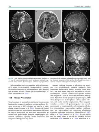 Schizencephaly is always associated with polymicrogy-
ria; it means cleft brain and is characterized by a commu-
nication between ventricle and subarachnoid space. Cortical
lips are either attached (closed lips) or separated by CSF
(open lips) (Barkovich 2002).
10.3 Clinical Presentation
Broad spectrum of ranging from intellectual impairment to
hemiparesis, tetraparesis, and drug-resistant epilepsy. Sei-
zures are present in 80 % of cases and may be of many
clinical types (Leventer et al. 2010). Severity of clinical
presentation and age at presentation are related to the extent
of cortical involvement and associated abnormalities. In
severe cases, pseudobulbar paralysis (oropharyngeal dys-
function, dysarthria), epilepsy, mental retardation, and
congenital arthrogyposis may result.
Another syndrome complex is polymicrogyria associ-
ated with megalencephaly, postaxial syndactyly, cutis
marmorata, distinct facial features including frontal boss-
ing, a low nasal bridge, large eyes, and midfacial vascular
malformations. Affected children have epileptic seizures
and delayed or a lack of motor and intellectual develop-
ment. Apart from mostly perisylvian polymicrogyria, MRI
shows (progressive) hydrocephalus, a thick corpus callo-
sum, and caudal tonsillar displacement. These megalen-
cephalies associated with polymicrogyria were formerly
denominated as megalencephaly–polymicrogyria–polydac-
tyly–hydrocephalus, macrocephaly–capillary malforma-
tion, and macrocephaly–cutis marmorata telangiectata
congenita syndromes, respectively (Garavelli et al. 2007;
Gripp et al. 2009; Barkovich et al. 2012). Polymicrogyria
may be among others a part of the following diseases
(Barkovich 2010; Hermier et al. 2010; Barkovich et al.
Fig. 17 Large subcortical heterotopia with a curvilinear pattern in a
3.5 year old boy with a right-sided spastic hemiparesis and daily drug-
resistant atonic seizures. The heteropia is isointense to gray matter in
all sequences and resembles enfolded polymicrogyriform cortex. Note
the abnormal sulcation and the fact that the affected hemisphere is
small as compared to the opposite hemisphere (a–f)
150 H. Urbach and S. Greschus
 