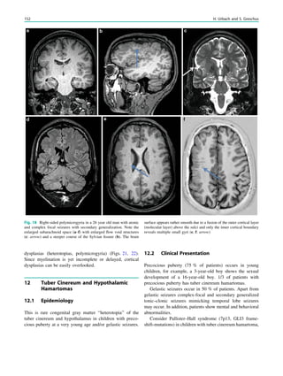 dysplasias (heterotopias, polymicrogyria) (Figs. 21, 22).
Since myelination is yet incomplete or delayed, cortical
dysplasias can be easily overlooked.
12 Tuber Cinereum and Hypothalamic
Hamartomas
12.1 Epidemiology
This is rare congenital gray matter ‘‘heterotopia’’ of the
tuber cinereum and hypothalamus in children with preco-
cious puberty at a very young age and/or gelastic seizures.
12.2 Clinical Presentation
Precocious puberty (75 % of patients) occurs in young
children, for example, a 3-year-old boy shows the sexual
development of a 16-year-old boy. 1/3 of patients with
precocious puberty has tuber cinereum hamartomas.
Gelastic seizures occur in 50 % of patients. Apart from
gelastic seizures complex-focal and secondary generalized
tonic–clonic seizures mimicking temporal lobe seizures
may occur. In addition, patients show mental and behavioral
abnormalities.
Consider Pallister–Hall syndrome (7p13, GLI3 frame-
shift-mutations) in children with tuber cinereum hamartoma,
Fig. 18 Right-sided polymicrogyria in a 26 year old man with atonic
and complex focal seizures with secondary generalization. Note the
enlarged subarachnoid space (a–f) with enlarged ﬂow void structures
(c: arrow) and a steeper course of the Sylvian ﬁssure (b). The brain
surface appears rather smooth due to a fusion of the outer cortical layer
(molecular layer) above the sulci and only the inner cortical boundary
reveals multiple small gyri (e, f: arrow)
152 H. Urbach and S. Greschus
 