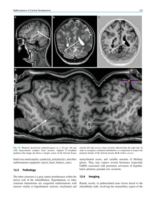 hand (ossa metacarpalia, syndactyly, polydactyly), and other
malformations (epiglottis, larynx, heart, kidneys, anus).
12.3 Pathology
The tuber cinereum is a gray matter protuberance within the
dorsal wall of the infundibulum. Hypothalamic or tuber
cinereum hamartomas are congenital malformations with
neurons similar to hypothalamic neurons, myelinated and
unmyelinated axons, and variable amounts of ﬁbrillary
gliosis. They may express several hormones (especially
GnRH) associated with premature activation of hypotha-
lamic–pituitary–gonadal axis secretion.
12.4 Imaging
Round, sessile, or pedunculated mass lesion dorsal to the
infundibular stalk, involving the mammillary region of the
Fig. 19 Bilateral perisylvian polymicrogryia in a 16 year old girl
with sleep-related complex focal seizures. Sagittal T1-weighted
gradient echo image (a) shows a steeper course of the Sylvian ﬁssure
and the left side (arrow) more severely affected than the right side. In
order to recognize a bilateral distribution, it is important to inspect the
posterior border of the Sylvian ﬁssure (b–d: hollow arrow)
Malformations of Cortical Development 153
 
