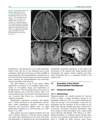 hypothalamus, with attachment to one or both mammillary
bodies is seen. The size is a few millimeters up to several
centimeters, which does not increase on follow-up MRI. In
larger hamartomas, the intrahypothalamic component lies in
the wall of the third ventricle between the postcommissural
fornix anteriorly, the mammillothalamic tract posteriorly,
and the mammillary body inferiorly.
The signal intensity is close to gray matter: slightly
hypointense or isointense on T1-weighted, slightly hyper-
intense on T2-weighted images, and hyperintense on
FLAIR sequences. Note that small lesions can be missed on
FLAIR sequences due to CSF ﬂow artifacts. There is no
contrast enhancement. Cystic portions and calciﬁcations are
rare; if present other lesions (e.g., craniopharyngioma)
should be considered.
Hypothalamic hamartomas associated with epilepsy
have a sessile attachment to the hypothalamus and dis-
place normal hypothalamic structures, whereas those
associated with precocious puberty alone are rather
pedunculated (Valdueza et al. 1994; Freeman et al. 2004;
Frazier et al. 2009).
Some patients also have temporal arachnoid cysts and
(more common) unilateral or bilateral anterior temporal
gray–white matter demarcation loss. For those with unilat-
eral abnormality it is ipsilateral to the side of predominant
hypothalamic hamartoma attachment. It may reﬂect ictal
involvement of the temporal lobe during postnatal brain
development and suggests anterior temporal gray–white
matter demarcation loss as a maturation disorder of the
temporal pole.
13 Anomalies of the Ventral
Prosencephalon Development
13.1 Holoprosencephalies
13.1.1 Epidemiology
Holoprosencephaly was initially described by Yakovlev
(1959). It means a median holosphere instead of two
hemispheres (Yakovlev 1959). It is a brain malformation in
which the cleavage of the telencephalic vesicle into two
hemispheres and the separation of the eye ﬁelds are dis-
turbed. This cleavage normally takes place around week 6
of gestation. Associated craniofacial abnormalities range
from cyclopia to mild microcephaly with a single central
incisor (Roessler and Muenke 1999; Moog et al. 2001).
Holoprosencephaly is a continuous disease spectrum rang-
ing from severe (alobar) to mild (lobar) forms. The preva-
lence is 1:16,000 live births, however, many fetuses
Fig. 20 Focal polymicrogyria of
the left cingulate gyrus in a
21 year old woman with focal
frontomesial seizures since the
age of 1. The microgyri are not
visible on a 5 mm thick axial
FLAIR image (a: point). In
contrast, a 1 mm thick sagittal
T1-weighted gradient echo image
shows microgyri (b, d: unaffected
right side). A planar surface view
allows to compare both cingulate
gyri and displays the focal
polymicrogyria more clearly
(c: arrow)
154 H. Urbach and S. Greschus
 