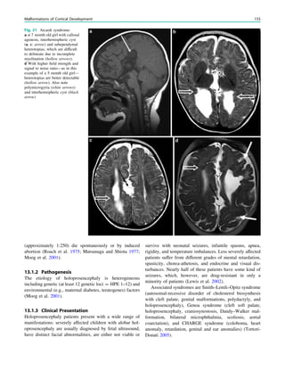 (approximately 1:250) die spontaneously or by induced
abortion (Roach et al. 1975; Matsunaga and Shiota 1977;
Moog et al. 2001).
13.1.2 Pathogenesis
The etiology of holoprosencephaly is heterogeneous
including genetic (at least 12 genetic loci = HPE 1–12) and
environmental (e.g., maternal diabetes, teratogenes) factors
(Moog et al. 2001).
13.1.3 Clinical Presentation
Holoprosencephaly patients present with a wide range of
manifestations: severely affected children with alobar hol-
oprosencephaly are usually diagnosed by fetal ultrasound,
have distinct facial abnormalities, are either not viable or
survive with neonatal seizures, infantile spasms, apnea,
rigidity, and temperature imbalances. Less severely affected
patients suffer from different grades of mental retardation,
spasticity, chorea-athetosis, and endocrine and visual dis-
turbances. Nearly half of these patients have some kind of
seizures, which, however, are drug-resistant in only a
minority of patients (Lewis et al. 2002).
Associated syndromes are Smith–Lemli–Opitz syndrome
(autosomal-recessive disorder of cholesterol biosynthesis
with cleft palate, genital malformations, polydactyly, and
holoprosencephaly), Genoa syndrome (cleft soft palate,
holoprosencephaly, craniosynostosis, Dandy–Walker mal-
formation, bilateral microphthalmia, scoliosis, aortal
coarctation), and CHARGE syndrome (coloboma, heart
anomaly, retardation, genital and ear anomalies) (Tortori-
Donati 2005).
Fig. 21 Aicardi syndrome:
a–c 7 month old girl with callosal
agenesis, interhemispheric cyst
(a, c: arrow) and subependymal
heterotopias, which are difﬁcult
to delineate due to incomplete
myelination (hollow arrows).
d With higher ﬁeld strength and
signal to noise ratio—as in this
example of a 5 month old girl—
heterotopias are better detectable
(hollow arrow). Also note
polymicrogyria (white arrows)
and interhemsipheric cyst (black
arrow)
Malformations of Cortical Development 155
 
