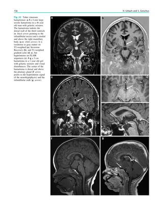 Fig. 22 Tuber cinereum
hamartomas: a–f a 4 mm large
sessile hamartoma in a 46 year
old man with gelastic seizures.
The hamartoma indents the
dorsal wall of the third ventricle
(e: black arrow pointing to the
infundibular recess) and is medial
and above the right mamillary
body (a–e: white arrow). It is
isointense to gray matter on
T2-weighted (a), Inversion
Recovery (b), and T1-weighted
gradient echo (d, e), but
hyperintense on FLAIR
sequences (c). f–g a 3 cm
hamartoma in a 1 year old girl
with gelastic seizures and visual
disturbances. The center of the
hamartoma is dorsal and above
the pituitary gland (f: arrow
points to the hyperintense signal
of the neurohypophysis) and the
infundibular stalk (g: arrow)
156 H. Urbach and S. Greschus
 