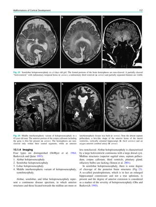 13.1.4 Imaging
Four types are distinguished (DeMyer et al. 1964;
Barkovich and Quint 1993):
1. Alobar holoprosencephaly
2. Semilobar holoprosencephaly
3. Lobar holoprosencephaly
4. Middle interhemispheric variant of holoprosencephaly,
syntelencephaly.
Alobar, semilobar, and lobar holoprosencephaly repre-
sent a continuous disease spectrum, in which anterior
structures and those located towards the midline are more or
less noncleaved. Alobar holoprosencephaly is characterized
by a large holoventricle continuous with a large dorsal cyst.
Midline structures (superior sagittal sinus, septum pelluci-
dum, corpus callosum, third ventricle, pituitary gland,
olfactory bulbs) are lacking (Simon et al. 2001).
In semilobar holoprosencephaly, there is some degree
of cleavage of the posterior brain structures (Fig. 23).
A so-called pseudosplenium, which is in fact an enlarged
hippocampal commissure and not a true splenium, is
present and the degree of anterior extension is considered
as a marker of the severity of holoprosencephaly (Oba and
Barkovich 1995).
Fig. 23 Semilobar holoprosencephaly in a 4 days old girl. The frontal portions of the brain hemispheres are non-cleaved. A partially cleaved
‘‘holoventricle’’ with rudimentary temporal horns (c: arrow), a rudimentary third ventricle (a: arrow) and partially separated thalami are visible
Fig. 24 Middle interhemispheric variant of holoprosencephaly in a
45 year old man. The anterior portion of the corpus callosum including
the genu is thin but present (a: arrow). The hemispheres are non-
cleaved only within their central segments, while an anterior
interhemispheric ﬁssure was built (c: arrow). Note the absent septum
pellucidum, a box-like shape of the anterior horns of the lateral
ventricles, vertically oriented hippocampi (b: thick arrows) and an
azygos anterior cerebral artery (b: arrow)
Malformations of Cortical Development 157
 