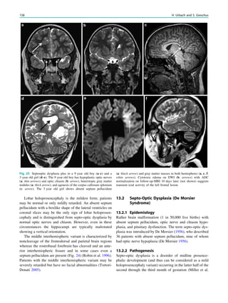 Lobar holoprosencephaly is the mildest form; patients
may be normal or only mildly retarded. An absent septum
pellucidum with a boxlike shape of the lateral ventricles on
coronal slices may be the only sign of lobar holoprosen-
cephaly and is distinguished from septo-optic dysplasia by
normal optic nerves and chiasm. However, even in these
circumstances the hippocampi are typically malrotated
showing a vertical orientation.
The middle interhemispheric variant is characterized by
noncleavage of the frontodorsal and parietal brain regions
whereas the rostrobasal forebrain has cleaved and an ante-
rior interhemispheric ﬁssure and in some cases even a
septum pellucidum are present (Fig. 24) (Robin et al. 1996).
Patients with the middle interhemispheric variant may be
severely retarded but have no facial abnormalities (Tortori-
Donati 2005).
13.2 Septo-Optic Dysplasia (De Morsier
Syndrome)
13.2.1 Epidemiology
Rather brain malformation (1 in 50,000 live births) with
absent septum pellucidum, optic nerve and chiasm hypo-
plasia, and pituitary dysfunction. The term septo-optic dys-
plasia was introduced by De Morsier (1956), who described
36 patients with absent septum pellucidum, nine of whom
had optic nerve hypoplasia (De Morsier 1956).
13.2.2 Pathogenesis
Septo-optic dysplasia is a disorder of midline prosence-
phalic development (and thus can be considered as a mild
holoprosencephaly variant) occurring in the latter half of the
second through the third month of gestation (Miller et al.
Fig. 25 Septooptic dysplasia plus in a 9 year old boy (a–c) and a
3 year old girl (d–e). The 9 year old boy has hypoplastic optic nerves
(a: thin arrows) and optic chiasm (b: arrow), heterotopic gray matter
nodules (a: thick arrow), and agenesis of the corpus callosum splenium
(c: arrow). The 3 year old girl shows absent septum pellucidum
(a: black arrow) and gray matter masses in both hemispheres (a, c, f:
white arrows). Cytotoxic edema on DWI (b: arrows) with ADC
normalization on follow-up-MRI 10 days later (not shown) suggests
transient ictal activity of the left frontal lesion
158 H. Urbach and S. Greschus
 