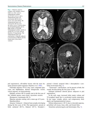 pial angiomatosis, off-midline lesions with the more fre-
quent parietooccipital angiomas (Enjolras et al. 1985).
Choroidal angioma (70 %) may cause congenital glau-
coma and buphthalmos. Retinal telangiectatic vessels,
scleral angioma, iris heterochromia.
Epileptic seizures (90 %) usually start in the ﬁrst year of
life: infantile spasms, tonic–clonic, myoclonic seizures.
Hemiparesis, hemianopia (66 %).
Migraine episodes starting with a mean age of 8 years.
Hypothyroidism.
Imaging: Unilateral [ bilateral brain atrophy developing
during the ﬁrst years of life. Pial angiomatosis: present at
birth, unilateral (80 %), bilateral (20 %). Occipital [
parietal [ frontal, temporal lobes [ diencephalon [ cere-
bellar involvement (Fig. 2).
‘‘Tram-track’’ calciﬁcations: can be present at birth, but
usually develop during the ﬁrst years of life.
Enlarged ipsilateral choroid plexus subjacent to pial
angiomatosis.
In the early stage, increased white matter volume and
T2-weighted signal due to accelerated myelin maturation.
In late stages, atrophy, gliosis, and compensatory thick
dipole and hyperpneumatized sinuses.
Orbital enhancement ([50 %) due to choroidal angioma,
periorbital soft tissues, bony orbit, and frontal lobes.
Sometimes polymicrogyria and heterotopias (Fig. 3).
Fig. 1 Tuberous sclerosis
complex with multiple cortical
tubers (c: white arrows),
subependymal nodules
(a, b: black arrows), and a
subependymal giant cell
astrocytoma (b, d: hollow
arrow). Six years before, the
subependymal giant cell
astrocytoma did not exist
(a: hollow arrow). Cortical tubers
are histopathologically and on
MRI similar to FCD IIB.
Subependymal nodules calcify in
around 50 % of cases and are
therefore T2-hypointense. The
subependymal giant cell
astrocytoma is typically adjacent
to the Foramen of Monro and the
frontal horn of the lateral
ventricle
Neurocutaneous Diseases (Phakomatoses) 167
 