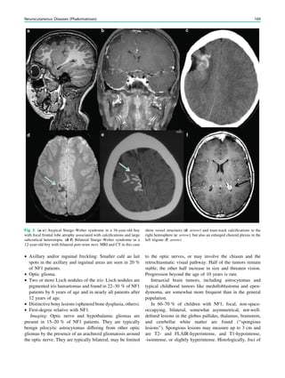 • Axillary and/or inguinal freckling: Smaller café au lait
spots in the axillary and inguinal areas are seen in 20 %
of NF1 patients.
• Optic glioma.
• Two or more Lisch nodules of the iris: Lisch nodules are
pigmented iris hamartomas and found in 22–30 % of NF1
patients by 6 years of age and in nearly all patients after
12 years of age.
• Distinctive bony lesions (sphenoid bone dysplasia, others).
• First-degree relative with NF1.
Imaging: Optic nerve and hypothalamic gliomas are
present in 15–20 % of NF1 patients. They are typically
benign pilocytic astrocytomas differing from other optic
gliomas by the presence of an arachnoid gliomatosis around
the optic nerve. They are typically bilateral, may be limited
to the optic nerves, or may involve the chiasm and the
retrochiasmatic visual pathway. Half of the tumors remain
stable; the other half increase in size and threaten vision.
Progression beyond the age of 10 years is rare.
Intraaxial brain tumors, including astrocytomas and
typical childhood tumors like medulloblastoma and epen-
dymoma, are somewhat more frequent than in the general
population.
In 60–70 % of children with NF1, focal, non-space-
occupying, bilateral, somewhat asymmetrical, not-well-
deﬁned lesions in the globus pallidus, thalamus, brainstem,
and cerebellar white matter are found (‘‘spongious
lesions’’). Spongious lesions may measure up to 3 cm and
are T2- and FLAIR-hyperintense, and T1-hypointense,
-isointense, or slightly hyperintense. Histologically, foci of
Fig. 3 (a–c) Atypical Sturge–Weber syndrome in a 16-year-old boy
with focal frontal lobe atrophy associated with calciﬁcations and large
subcortical heterotopia. (d–f) Bilateral Sturge–Weber syndrome in a
12-year-old boy with bilateral port-wine nevi. MRI and CT in this case
show vessel structures (d: arrow) and tram-track calciﬁcations in the
right hemisphere (e: arrow), but also an enlarged choroid plexus in the
left trigone (f: arrow)
Neurocutaneous Diseases (Phakomatoses) 169
 