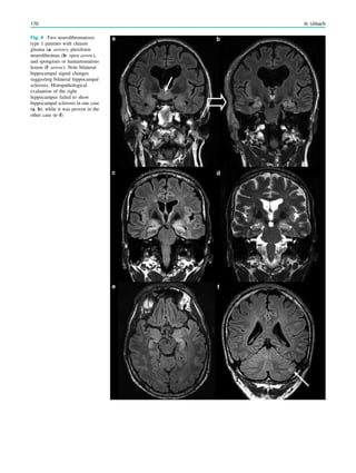 Fig. 4 Two neuroﬁbromatosis
type 1 patients with chiasm
glioma (a: arrow), plexiform
neuroﬁbromas (b: open arrow),
and spongious or hamartomatous
lesion (f: arrow). Note bilateral
hippocampal signal changes
suggesting bilateral hippocampal
sclerosis. Histopathological
evaluation of the right
hippocampus failed to show
hippocampal sclerosis in one case
(a, b), while it was proven in the
other case (c–f)
170 H. Urbach
 