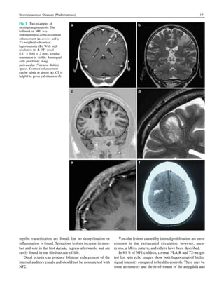 myelin vacuolization are found, but no demyelination or
inﬂammation is found. Spongious lesions increase in num-
ber and size in the ﬁrst decade, regress afterwards, and are
rarely found in the third decade of life.
Dural ectasia can produce bilateral enlargement of the
internal auditory canals and should not be mismatched with
NF2.
Vascular lesions caused by intimal proliferation are more
common in the extracranial circulation; however, aneu-
rysms, a Moya pattern, and others have been described.
In 80 % of NF1 children, coronal FLAIR and T2-weigh-
ted fast spin echo images show both hippocampi of higher
signal intensity compared to healthy controls. There may be
some asymmetry and the involvement of the amygdala and
Fig. 5 Two examples of
meningioangiomatosis: The
hallmark of MRI is a
leptomeningeal-cortical contrast
enhancement (a: arrow) and a
T2-weighted subcortical
hyperintensity (b). With high
resolution (c; d: 3T, voxel
0.47 9 0.64 9 2 mm), a radial
orientation is visible: Meningeal
cells proliferate along
perivascular (Virchow–Robin)
spaces. Contrast enhancement
can be subtle or absent (e). CT is
helpful to prove calciﬁcation (f)
Neurocutaneous Diseases (Phakomatoses) 171
 