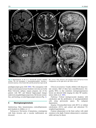 parahippocampal gyrus (Gill 2006). The consequence with
respect to postsurgical seizure freedom is not clear yet: In the
Bonn University epilepsy surgery program, one of ﬁve
patients with NF1 and bilateral hippocampal changes
underwent amygdalohippocampectomy. He became seizure-
free, and histology revealed hippocampal sclerosis (Fig. 4).
5 Meningioangiomatosis
Epidemiology: Rare, hamartomatous, cortical/leptomenin-
geal dysplasia in childen; m [ f.
Pathogenesis: Not known: A hamartoma, a meningioma
with brain invasion, and a vascular malformation are
discussed.
Clinical presentation: Usually children with drug-resis-
tant seizures. Half of them have neuroﬁbromatosis (fre-
quently NF2), so that sometimes meningioangiomatosis
lesions are detected while imaging for other NF manifes-
tations (Jallo et al. 2005).
Pathology: Cortical meningovascular dysplasia with
calciﬁcation and the proliferation of meningoendothelial
cells along perivascular spaces. No malignant
degeneration.
Imaging: Circumscribed lesion with (80 %) or without
calciﬁcations (20 %) and cortical and subcortical T2-
weighted hyperintensity.
Contrast enhancement on the brain surface with radial
extention in the depth. Contrast enhancement is sometimes
subtle and may be absent.
Fig. 6 Hypomelanosis of Ito in a 24-year-old severely disabled
woman. The left hemisphere is hemimegalencephalic, showing a
distorted anatomy of the frontal lobe and the perisylvian region (a, b,
d, e: arrow). Note, however, also irregular insula and Sylvian ﬁssure
conﬁguration on the right side (c, d: hollow arrow)
172 H. Urbach
 