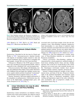 1994; Hennel et al. 2003; Wolf et al. 2005; Hsieh and
Chang 2011; Meuwissen and Mancini 2012).
9 Lipoid Proteinosis (Urbach–Wiethe
Syndrome)
Epidemiology: Described for the ﬁrst time by Urbach and
Wiethe in 1929. Autosomal-recessive inherited disorder
with deposits of amorphous hyaline material in skin and
mucosal membranes and of calciﬁcations in amygdala and
basal ganglia. Around 300 cases have been described.
Pathogenesis: Mutation of the ECM1 gene on chromo-
some 1q21 encodimg for the glycoprotein ECM1, which is
expressed in skin, endothelial cells, and developing bone.
Clinical presentation: Skin changes with thickening, scar-
ring, and xanthelasma-like nodules of the eyelids. Hoarseness
since childhood; thin and fragile hair. Epileptic seizures may
occur; cognitive deﬁcits and lack of emotional ‘‘involvement’’
are predominant clinical symptoms (Claeys et al. 2007).
Imaging: Symmetric, half-moon-shaped calciﬁcations of
the amygdalae are pathognomonic. Calciﬁcations may also
occur in the hippocampus, parahippocampal gyrus, and
striate (Gonçalves et al. 2010) (Fig. 7).
10 Linear Scleroderma (en coup de sabre
syndrome) and Parry–Romberg
Syndrome
Epidemiology: Linear scleroderma is an indented, vertical,
colorless line of skin on the forehead, also called en coup de
sabre, meaning ‘‘sword stroke’’ syndrome. It is typically
associated with a focal linear atrophy of the skin and sub-
cutaneous tissue. Parry–Romberg syndrome (progressive
facial hemiatrophy) is a rare disease of unknown origin
clinically sometimes associated with focal seizures and even
epilepsia partialis continua. Several case reports indicate a
close relationship between both entities (Carreño et al. 2007;
Chiang et al. 2009; Longo et al. 2011; Seifert et al. 2011).
Pathogenesis: The exact pathogenesis is unclear. Some
cases of Parry–Romberg syndrome are associated with
Rasmussen encephalitis.
Clinical presentation: Parry–Romberg syndrome is
characterized by a slowly progressive, unilateral atrophy of
facial tissue, including muscles, bones, and skin. Atrophy
typically starts in the ﬁrst or second decade of life, slowly
progresses over several years, and eventually becomes sta-
ble. Neurological involvement includes focal seizures
(Epilepsia partialis continua), migraine, and facial pain.
Imaging: Unilateral progressive atrophy of skin, subcu-
taneous tissue, and bones of the face. Progressive hemiat-
rophy of the ipsilateral hemisphere and sometimes signal
changes like those in Rasmussen encephalitis (initial
swelling and hyperintense signal of the cortex with periin-
sular accentuation; later on progressive atrophy of the
hyperintense tissue) (Fig. 8).
References
Bouwes Bavinck JN, van de Kamp JJP (1985) Organoid naevus
phakomatosis: Schimmelpenning–Feuerstein–Mims syndrome. Br
J Derm 113:491–492
Carreño M, Donaire A, Barceló MI et al (2007) Parry–Romberg
syndrome and linear scleroderma in coup de sabre mimicking
Rasmussen encephalitis. Neurology 68(16):1308–1310
Fig. 8 Parry–Romberg syndrome and Rasmussen encephalitis in a
16-year-old boy. Initially, atrophic skin, subcutaneous and bone tissue
(a: arrow) as well as cortical swelling suggestive of the acute stage of
Rasmussen encephalitis (a: open arrow) were observed. Atrophic skin
changes slowly progressed (b, c: arrows), and histologically proven
Rasmussen encephalitis evolved into a chronic stage with tissue
atrophy
Neurocutaneous Diseases (Phakomatoses) 175
 