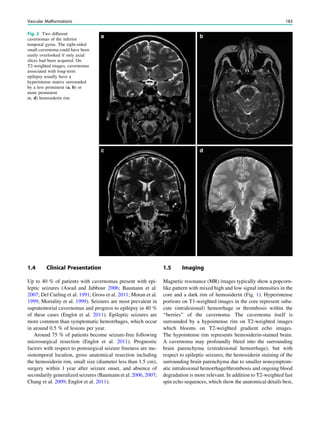 1.4 Clinical Presentation
Up to 40 % of patients with cavernomas present with epi-
leptic seizures (Awad and Jabbour 2006; Baumann et al.
2007; Del Curling et al. 1991; Gross et al. 2011; Moran et al.
1999; Moriality et al. 1999). Seizures are most prevalent in
supratentorial cavernomas and progress to epilepsy in 40 %
of these cases (Englot et al. 2011). Epileptic seizures are
more common than symptomatic hemorrhages, which occur
in around 0.5 % of lesions per year.
Around 75 % of patients become seizure-free following
microsurgical resection (Englot et al. 2011). Prognostic
factors with respect to postsurgical seizure freeness are me-
siotemporal location, gross anatomical resection including
the hemosiderin rim, small size (diameter less than 1.5 cm),
surgery within 1 year after seizure onset, and absence of
secondarily generalized seizures (Baumann et al. 2006, 2007;
Chang et al. 2009; Englot et al. 2011).
1.5 Imaging
Magnetic resonance (MR) images typically show a popcorn-
like pattern with mixed high and low signal intensities in the
core and a dark rim of hemosiderin (Fig. 1). Hyperintense
portions on T1-weighted images in the core represent suba-
cute (intralesional) hemorrhage or thrombosis within the
‘‘berries’’ of the cavernoma. The cavernoma itself is
surrounded by a hypointense rim on T2-weighted images
which blooms on T2-weighted gradient echo images.
The hypointense rim represents hemosiderin-stained brain.
A cavernoma may profoundly bleed into the surrounding
brain parenchyma (extralesional hemorrhage), but with
respect to epileptic seizures, the hemosiderin staining of the
surrounding brain parenchyma due to smaller nonsymptom-
atic intralesional hemorrhage/thrombosis and ongoing blood
degradation is more relevant. In addition to T2-weighted fast
spin echo sequences, which show the anatomical details best,
Fig. 2 Two different
cavernomas of the inferior
temporal gyrus. The right-sided
small cavernoma could have been
easily overlooked if only axial
slices had been acquired. On
T2-weighted images, cavernomas
associated with long-term
epilepsy usually have a
hyperintense matrix surrounded
by a less prominent (a, b) or
more prominent
(c, d) hemosiderin rim
Vascular Malformations 183
 