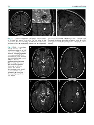 Fig. 4 MRI in a 14-year-old girl
initially presenting with a
transient difﬁculty to use her right
arm was uneventful except for a
small left insular developmental
venous anomaly (a, b). Four
years later, the patient presented
with two complex focal seizures.
MRI now showed a
pathologically proven insular
Zabramski type 1 cavernoma
with intralesional subacute
hemorrhage (c, d, hollow
arrows). The adjacent
developmental venous anomaly
is characterized by caput
meduase (b, d, arrows) and a
draining subependymal vein
(not shown)
Fig. 3 A 53-year-old man presented with epilepsia partialis continua
of the right neck muscles for 4 weeks. One year before he had
observed this phenomenon for 1 day. Axial ﬂuid-attenuated inversion
recovery (FLAIR) (a), T2-weighted gradient echo (b), T1-weighted
spin echo (c), and coronal FLAIR (d) images show a Zabramski type 1
cavernoma. Intralesional hemorrhage and adjacent edema (d, arrows)
are likely the reason why the patient presented with epilepsia partialis
continua
184 H. Urbach and T. Krings
 
