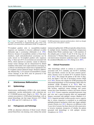 T2-weighted gradient echo or susceptibility-weighted
sequences are mandatory to discover additional so-called
Zabramski type 4 cavernomas (Zabramski et al. 1994).
However, because of susceptibility artefacts at bone–brain
interfaces, small cortical/subcortical cavernomas can be
easily missed on T2-weighted gradient echo sequences
(Fig. 2). Since up to 20 % of cavernomas are associated with
DVAs, which represent an anatomic variant of otherwise
normal venous drainage and are characterized by dilated
medullary white matter veins (caput medusae) converging on
a collector vein draining into a dural sinus or ependymal vein,
T1-weighted contrast-enhanced images should be addition-
ally obtained (Fig. 4). If a mixed cavernoma/DVA is found,
venous drainage of the DVA must be preserved if the
cavernoma is surgically removed.
2 Arteriovenous Malformations
2.1 Epidemiology
Arteriovenous malformation (AVM) is the most common
symptomatic vascular malformation, with a detection rate
of 1.2/100,000 person-years (Stapf et al. 2001). The most
common presentation is AVM-related hemorrhage, with an
annual hemorrhage rate that ranges between 2.8 % (Stapf
et al. 2006) and 4.6 % (daCosta et al. 2009).
2.2 Pathogenesis and Pathology
AVMs are abnormal collections of blood vessels wherein
arterial blood ﬂows into draining veins without the normal
interposed capillary bed. AVMs are typically solitary lesions.
In multiple lesions, hereditary hemorrhagic telangiectasia
(Rendu–Osler–Weber syndrome) type 1 with mutations of
the endoglin gene on bands 33 and 34 of the long arm of
chromosome 9, Wyburn–Mason syndrome, and cerebrofa-
cial arteriovenous metameric syndromes (types 1–3) should
be considered (Bharatha et al. 2012; Krings et al. 2007).
2.3 Clinical Presentation
After hemorrhage (which in contrast to cavernomas is
associated with 10 % mortality and 30–50 % morbidity
from each bleed), seizures are the most common presen-
tation. Seizures occur in around 30 % of patients (Garcin
et al. 2012). The younger the patient at the time of diag-
nosis, the higher is the risk of developing seizures (Stapf
et al. 2003). Seizure risk is higher for AVMs presenting with
intracranial hemorrhage or focal neurologic deﬁcit than for
incidental AVMs (Josephson et al. 2011). Male sex,
increasing AVM size, arterial borderzone location, frontal
lobe location, superﬁcial venous drainage, and venous
ectasia have been identiﬁed as relative risk factors (Garcin
et al. 2012). Venous congestion, perinidal hypoxemia, long
pial vein, and a space-occupying effect are angiographic
features associated with epileptic seizures (Shankar et al.
2012). Impaired perinidal cerebrovascular reserve capacity
due to venous congestion is considered as an underlying
pathophysiological mechanism which may trigger epileptic
seizures (Fiestra et al. 2011). However, no difference in the
5-year risk of seizures has been observed with conservative
or invasive treatment, irrespective of whether the patient
presented with hemorrhage or with epileptic seizures
(Josephson et al. 2012).
Fig. 5 Axial T2-weighted (a), FLAIR (b), and T1-weighted
(c) images demonstrating an intraparenchymal nidus of ﬂow voids
indicative of an arteriovenous malformation (AVM). T2-weighted and
FLAIR hyperintensity represents perifocal gliosis, which was thought
to be the cause of the patient’s seizures
Vascular Malformations 185
 