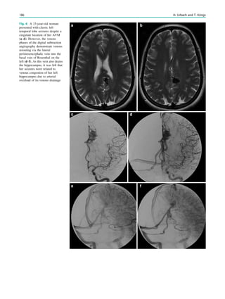 Fig. 6 A 33-year-old woman
presented with classic left
temporal lobe seizures despite a
cingulate location of her AVM
(a–d). However, the venous
phases of the digital subtraction
angiography demonstrate venous
rerouting via the lateral
perimesencephalic vein into the
basal vein of Rosenthal on the
left (d–f). As this vein also drains
the hippocampus, it was felt that
her seizures were related to
venous congestion of her left
hippocampus due to arterial
overload of its venous drainage
186 H. Urbach and T. Krings
 