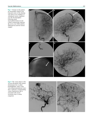 Fig. 7 Seizures in this patient
are presumably related to the
long pial course of the draining
vein (a, b, arrow) leading to a
widespread venous congestion
over the left hemisphere.
Following distal
microcatheterization (c) and
n-butyl cyanoacrylate injection
(d, arrow), the AVM could be
obliterated (e) and the seizures
stopped
Fig. 8 The venous phase in this
34-year-old patient with seizures
demonstrates the so-called
pseudophlebitic aspect of the
veins (dilated parenchymal veins)
that is indicative of longstanding
venous hypertension that is
associated with seizure
occurrence due to venous
congestion
Vascular Malformations 187
 